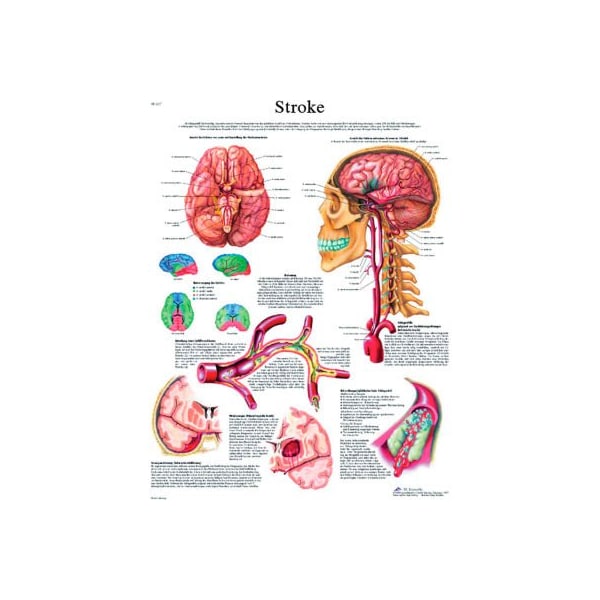 Fabrication Enterprises 3B Anatomical Chart - Stroke Chart Paper 12-4629P - main